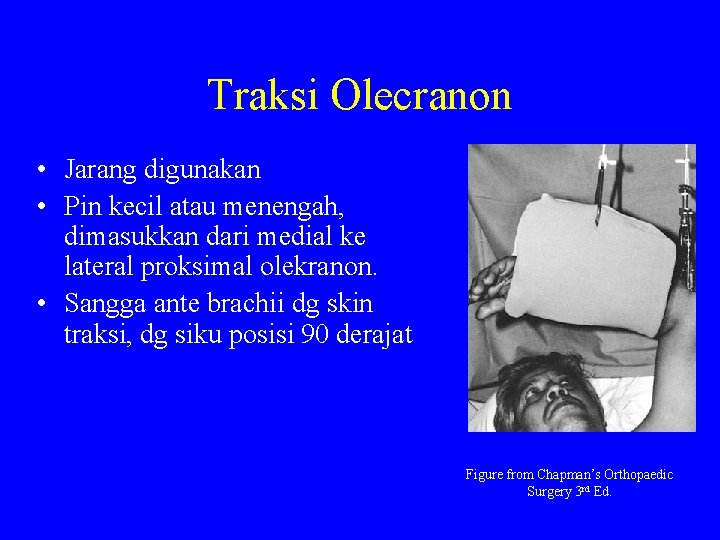 Traksi Olecranon • Jarang digunakan • Pin kecil atau menengah, dimasukkan dari medial ke