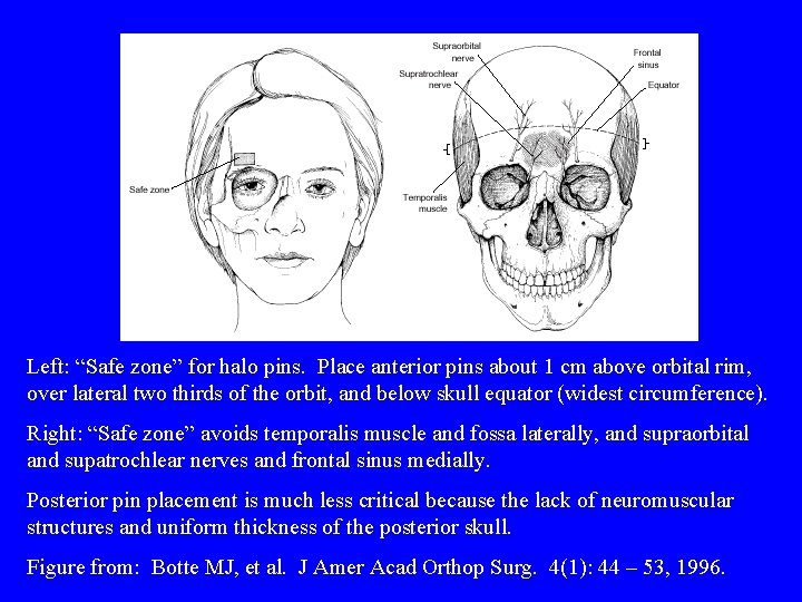Left: “Safe zone” for halo pins. Place anterior pins about 1 cm above orbital