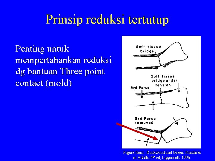 Prinsip reduksi tertutup Penting untuk mempertahankan reduksi dg bantuan Three point contact (mold) Figure