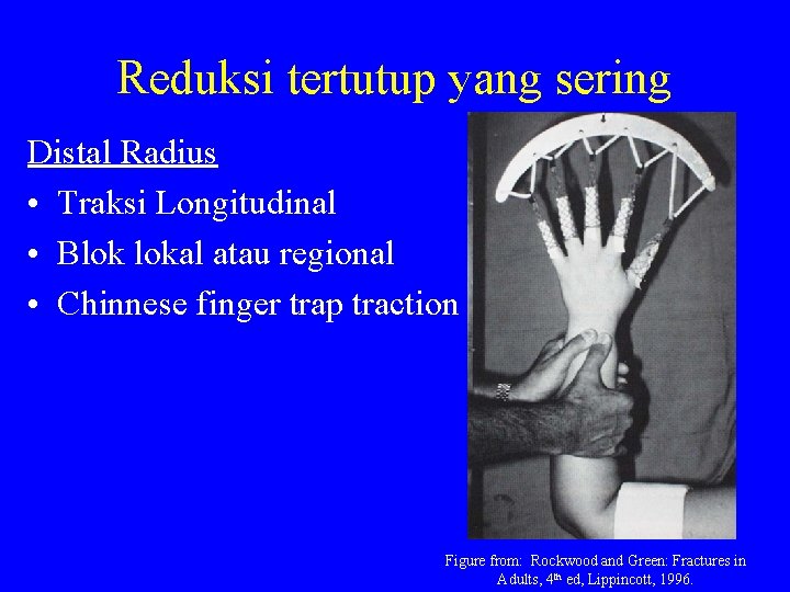 Reduksi tertutup yang sering Distal Radius • Traksi Longitudinal • Blok lokal atau regional