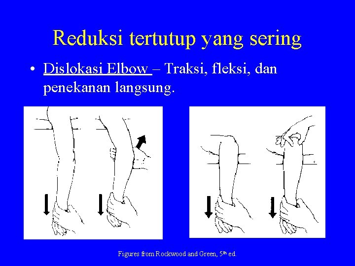Reduksi tertutup yang sering • Dislokasi Elbow – Traksi, fleksi, dan penekanan langsung. Figures