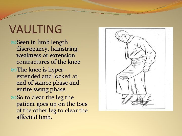 VAULTING Seen in limb length discrepancy, hamstring weakness or extension contractures of the knee