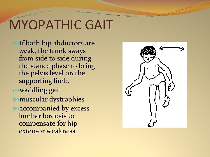 MYOPATHIC GAIT If both hip abductors are weak, the trunk sways from side to