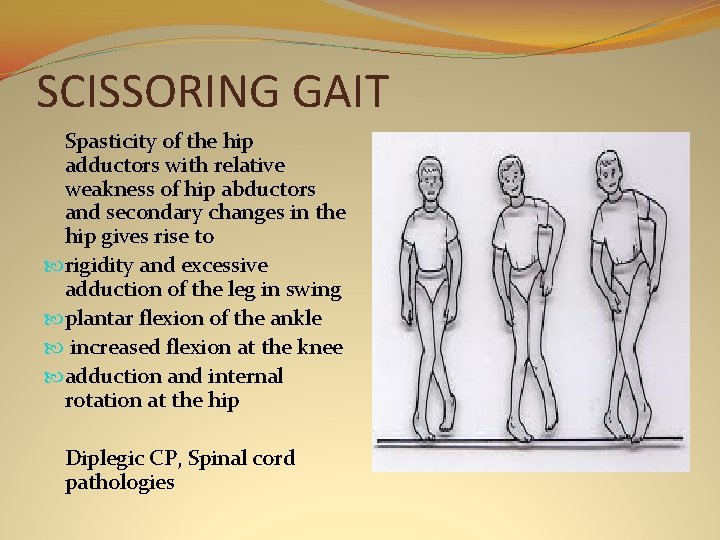 SCISSORING GAIT Spasticity of the hip adductors with relative weakness of hip abductors and