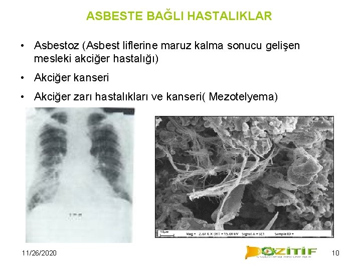 ASBESTE BAĞLI HASTALIKLAR • Asbestoz (Asbest liflerine maruz kalma sonucu gelişen mesleki akciğer hastalığı)