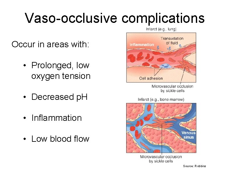 Vaso-occlusive complications Occur in areas with: • Prolonged, low oxygen tension • Decreased p.