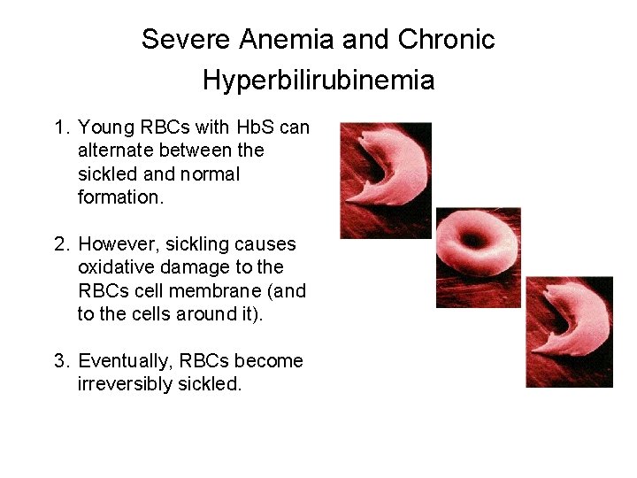 Severe Anemia and Chronic Hyperbilirubinemia 1. Young RBCs with Hb. S can alternate between