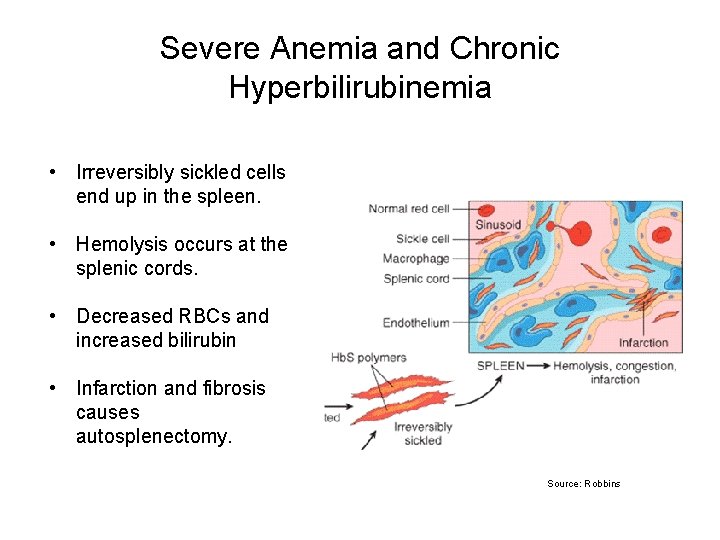 Severe Anemia and Chronic Hyperbilirubinemia • Irreversibly sickled cells end up in the spleen.