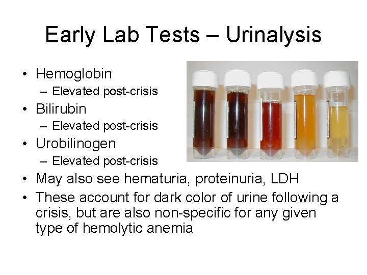 Early Lab Tests – Urinalysis • Hemoglobin – Elevated post-crisis • Bilirubin – Elevated