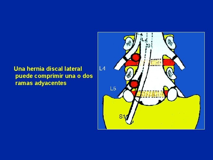 Una hernia discal lateral puede comprimir una o dos ramas adyacentes 