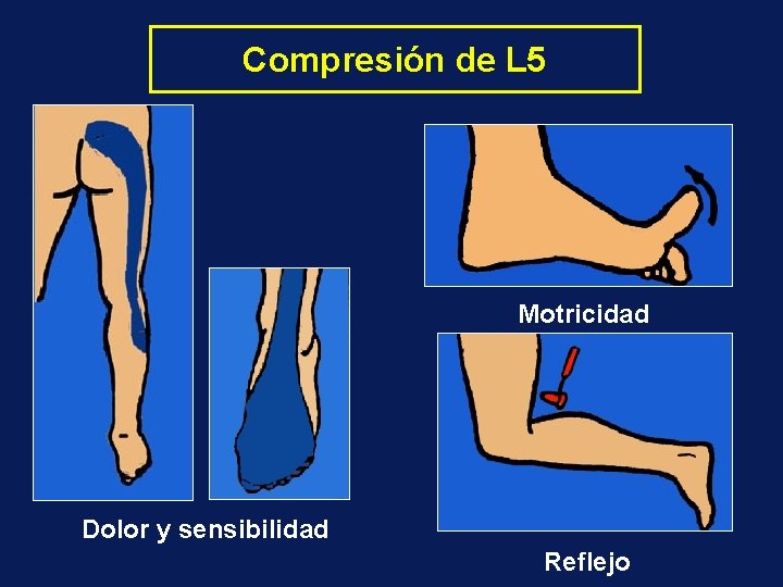 Compresión de L 5 Motricidad Dolor y sensibilidad Reflejo 