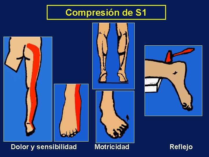 Compresión de S 1 Dolor y sensibilidad Motricidad Reflejo 