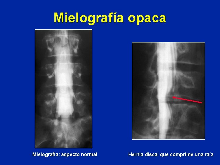 Mielografía opaca Mielografía: aspecto normal Hernia discal que comprime una raíz 