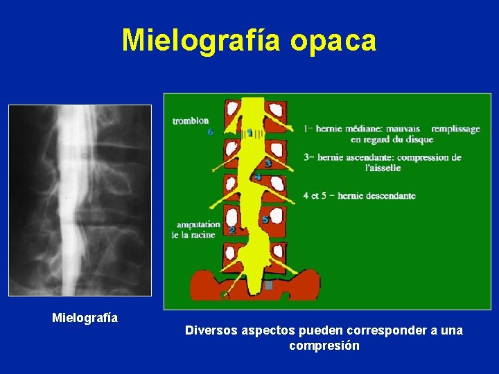 Mielografía opaca Mielografía Diversos aspectos pueden corresponder a una compresión 