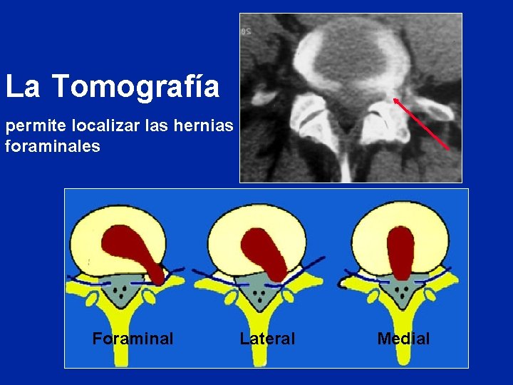 La Tomografía permite localizar las hernias foraminales Foraminal Lateral Medial 