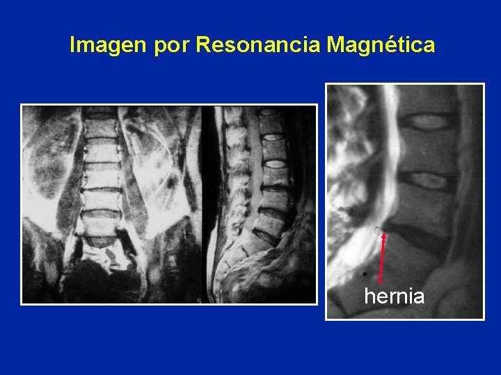 Imagen por Resonancia Magnética hernia 