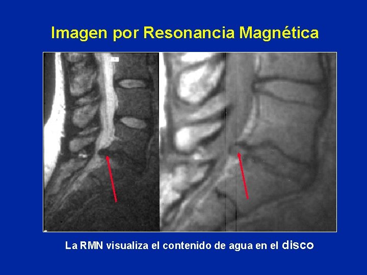 Imagen por Resonancia Magnética La RMN visualiza el contenido de agua en el disco