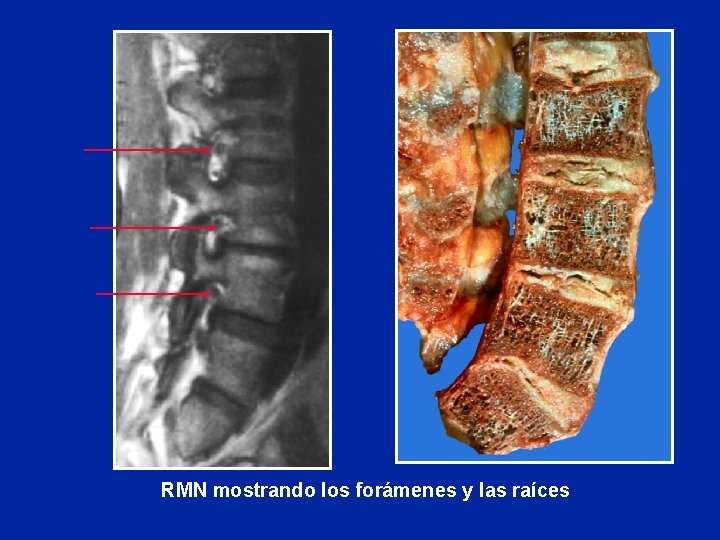 RMN mostrando los forámenes y las raíces 