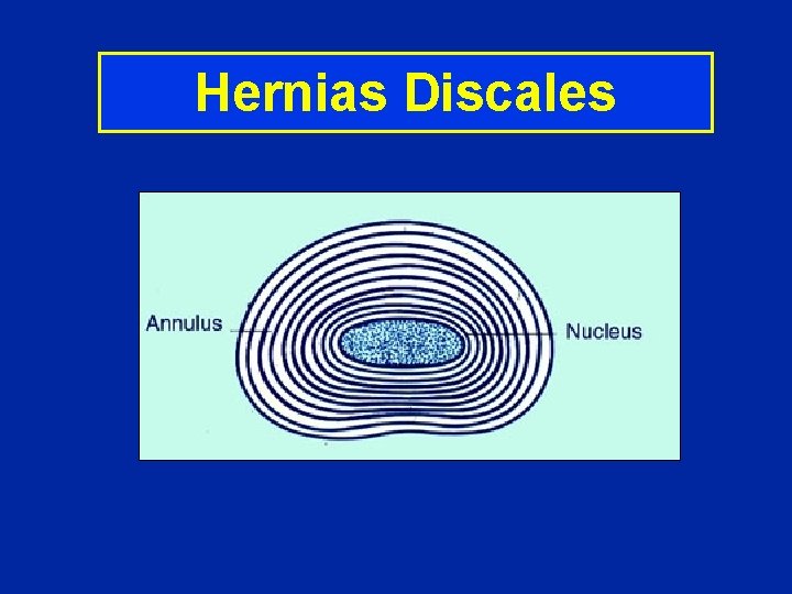 Hernias Discales 