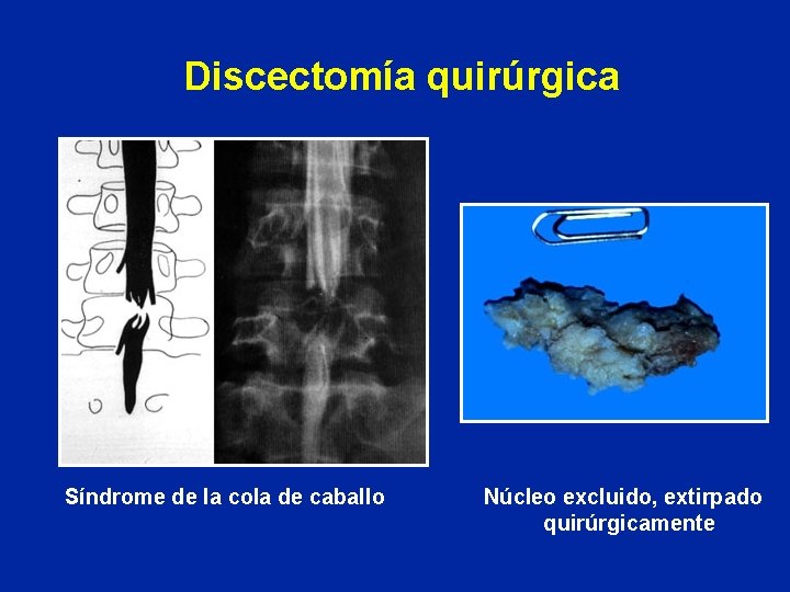 Discectomía quirúrgica Síndrome de la cola de caballo Núcleo excluido, extirpado quirúrgicamente 