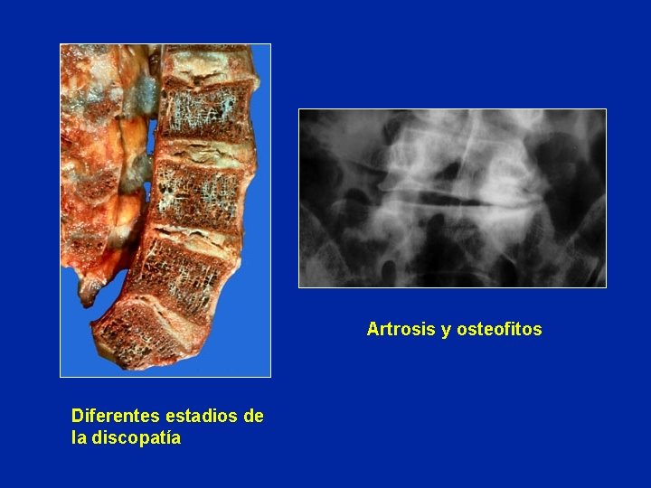 Artrosis y osteofitos Diferentes estadios de la discopatía 