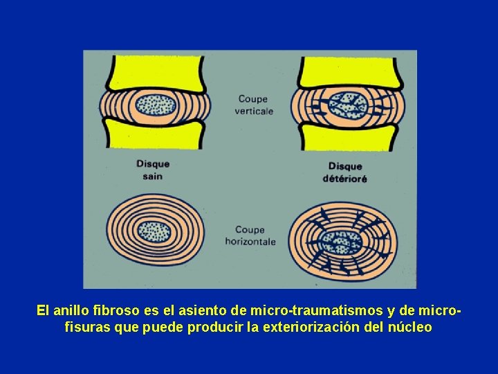 El anillo fibroso es el asiento de micro-traumatismos y de microfisuras que puede producir