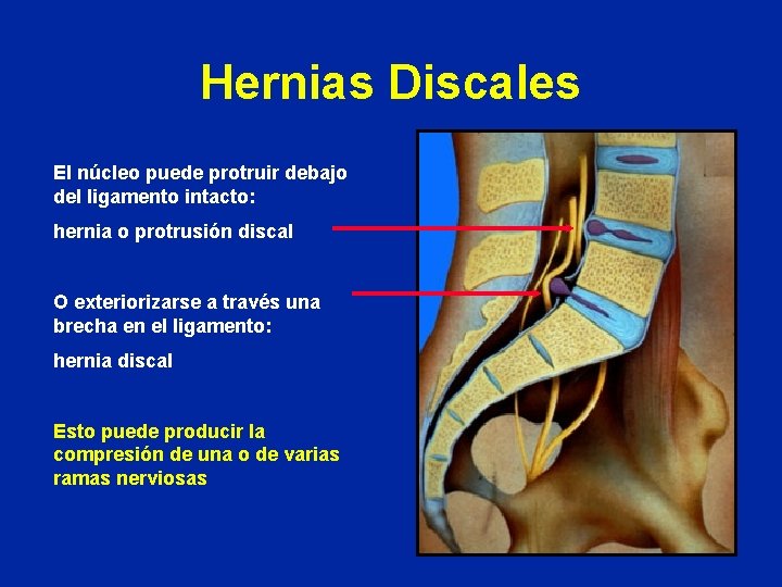 Hernias Discales El núcleo puede protruir debajo del ligamento intacto: hernia o protrusión discal