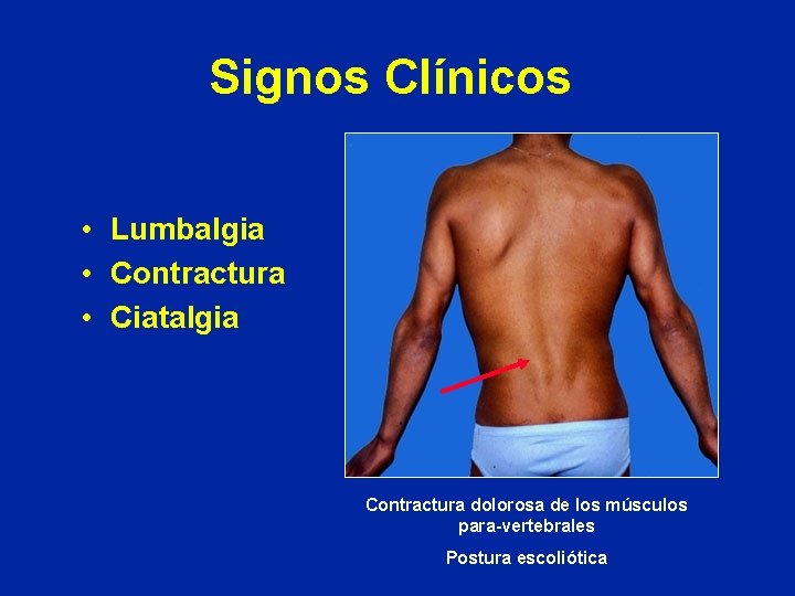 Signos Clínicos • Lumbalgia • Contractura • Ciatalgia Contractura dolorosa de los músculos para-vertebrales