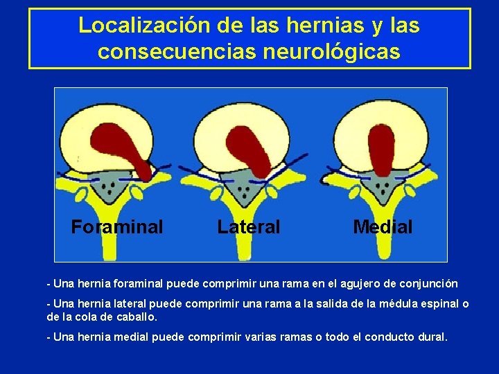 Localización de las hernias y las consecuencias neurológicas Foraminal Lateral Medial - Una hernia