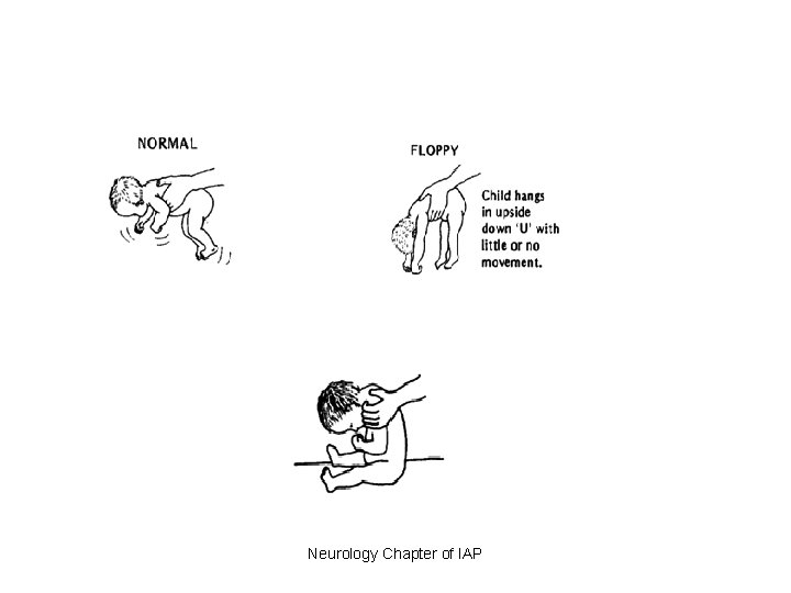 Neurology Chapter of IAP 