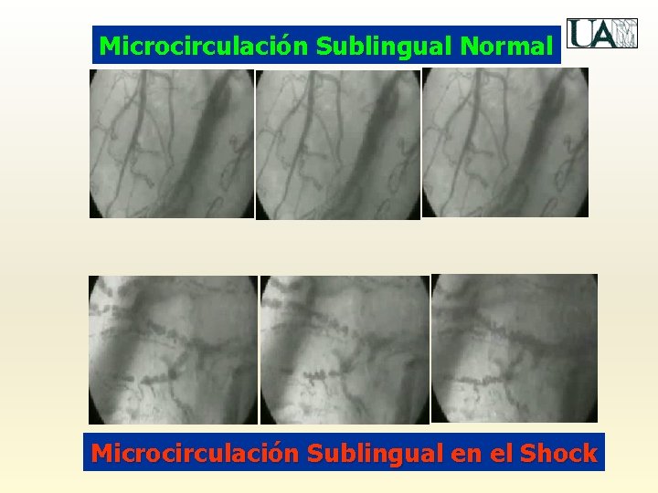 Microcirculación Sublingual Normal Microcirculación Sublingual en el Shock 