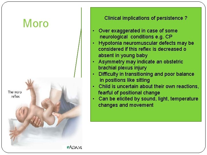 Moro Clinical implications of persistence ? • Over exaggerated in case of some neurological