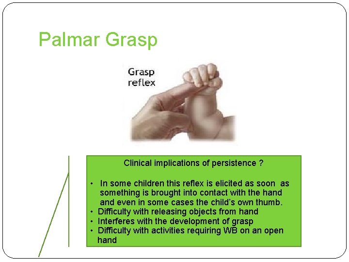 Palmar Grasp Clinical implications of persistence ? • In some children this reflex is