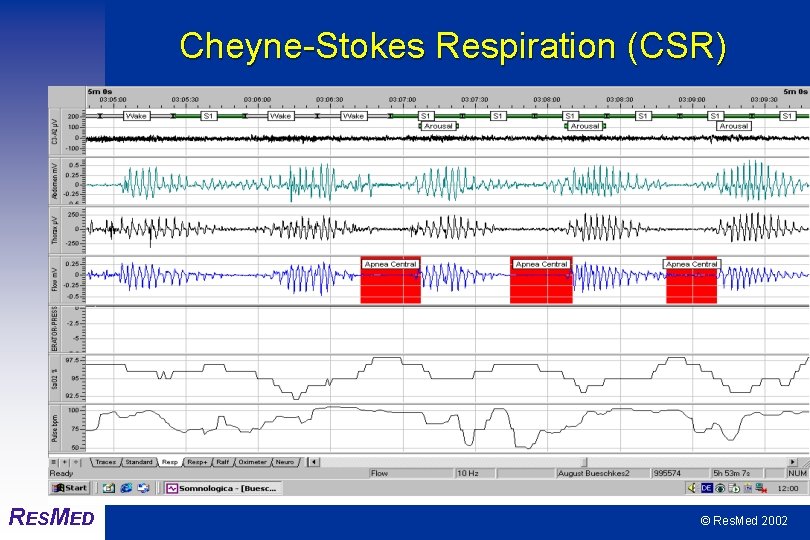 Cheyne-Stokes Respiration (CSR) RESMED © Res. Med 2002 