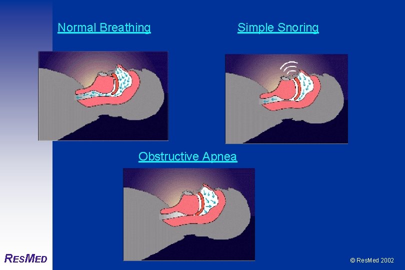 Normal Breathing Simple Snoring Obstructive Apnea RESMED © Res. Med 2002 