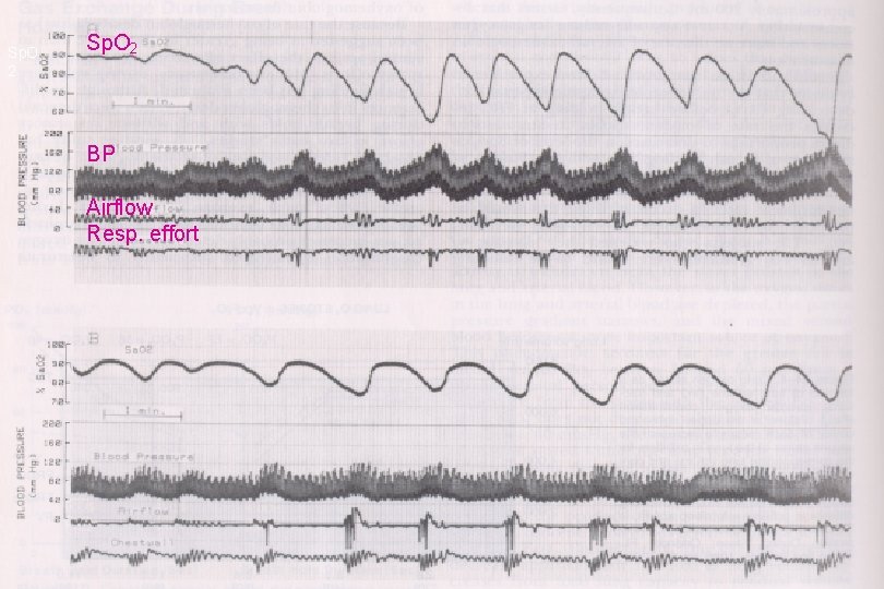 Sp. O 2 BP Airflow Resp. effort RESMED © Res. Med 2002 