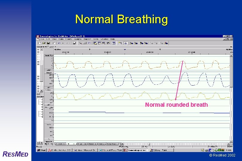 Normal Breathing Normal rounded breath RESMED © Res. Med 2002 