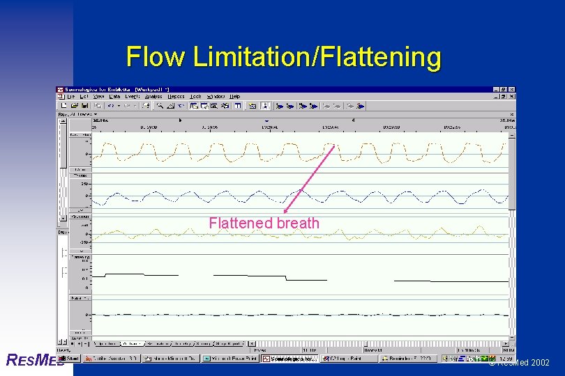 Flow Limitation/Flattening Flattened breath RESMED © Res. Med 2002 