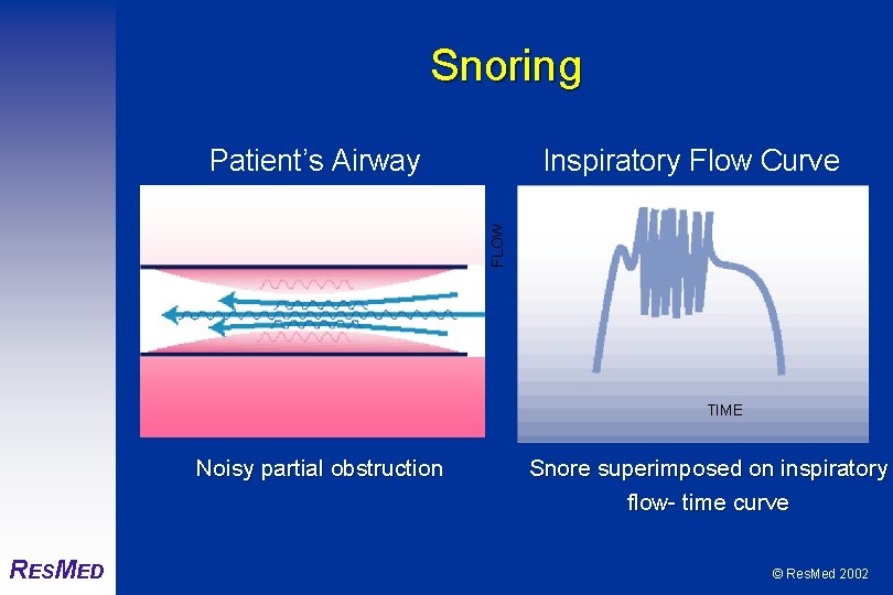 Snoring Inspiratory Flow Curve FLOW Patient’s Airway TIME Noisy partial obstruction RESMED Snore superimposed