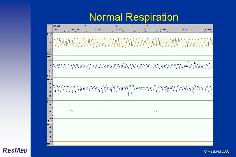 Normal Respiration RESMED © Res. Med 2002 