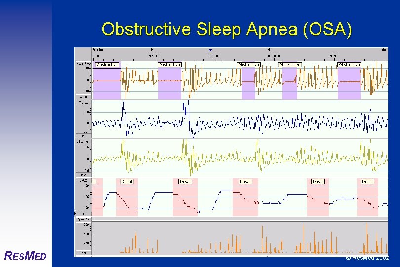 Obstructive Sleep Apnea (OSA) RESMED © Res. Med 2002 