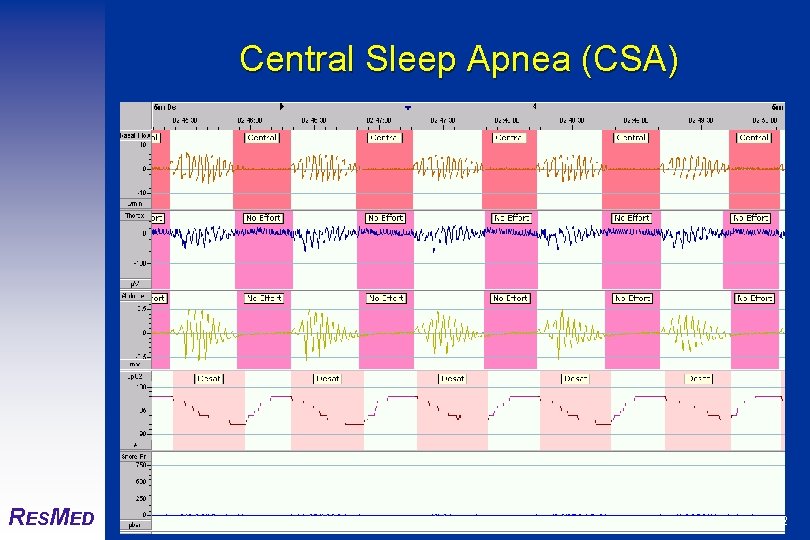 Central Sleep Apnea (CSA) RESMED © Res. Med 2002 