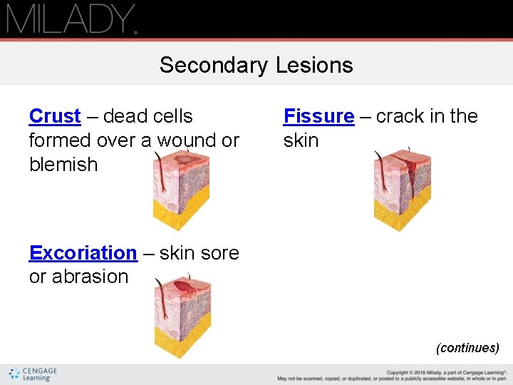 Secondary Lesions Crust – dead cells formed over a wound or blemish Fissure –