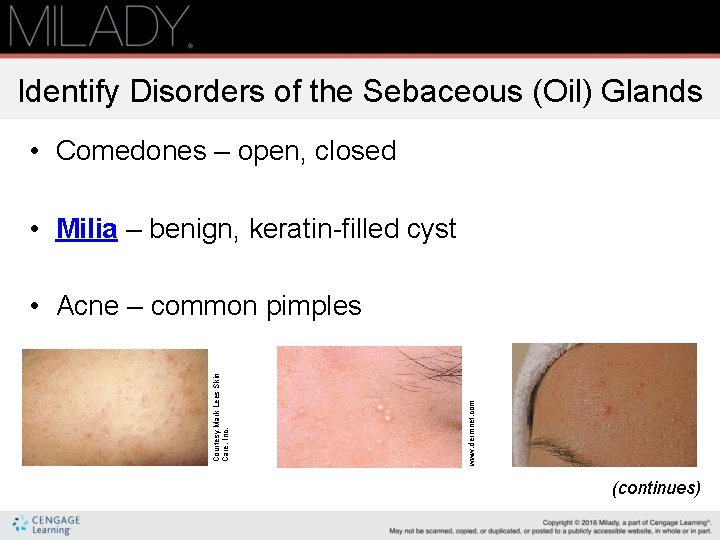Identify Disorders of the Sebaceous (Oil) Glands • Comedones – open, closed • Milia