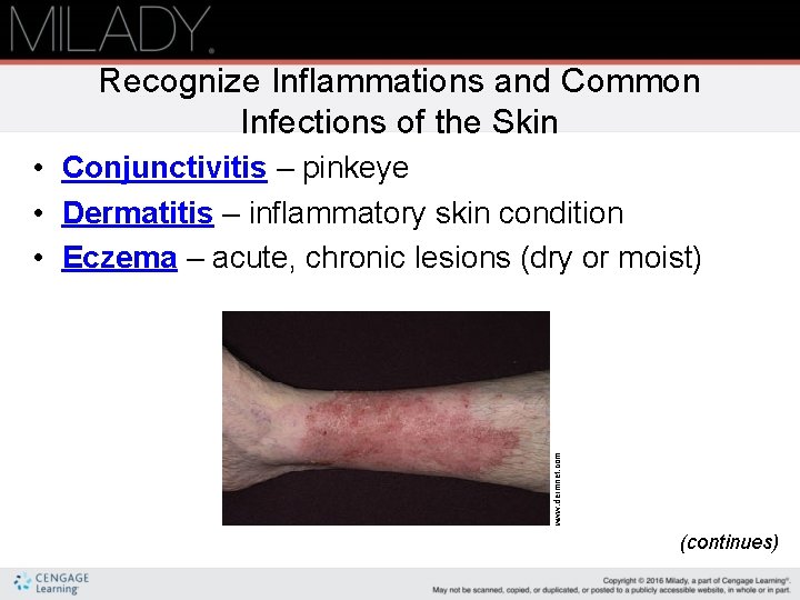 Recognize Inflammations and Common Infections of the Skin www. dermnet. com • Conjunctivitis –