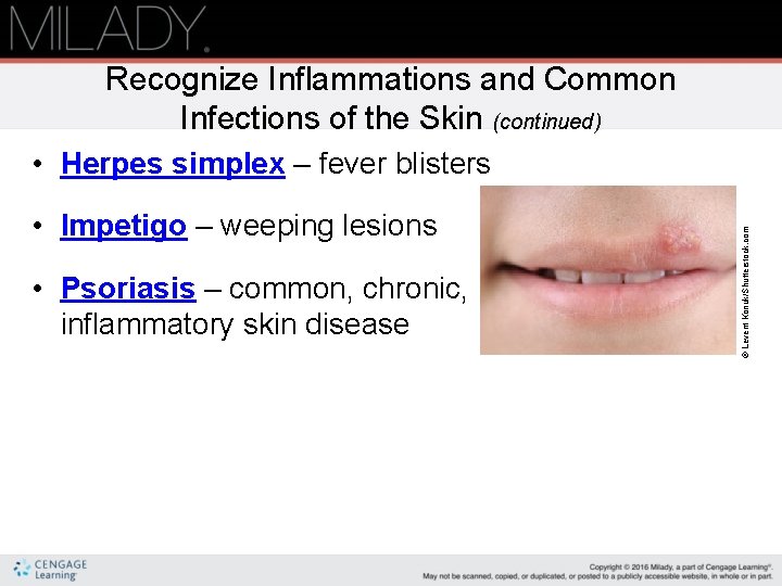 Recognize Inflammations and Common Infections of the Skin (continued) • Impetigo – weeping lesions