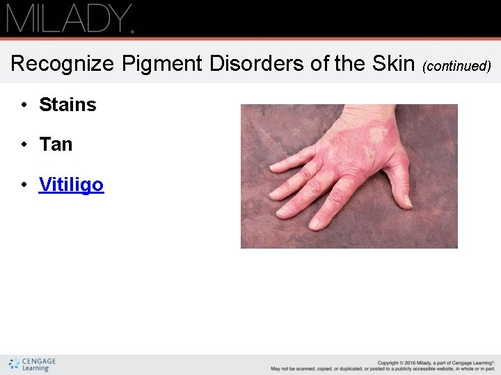 Recognize Pigment Disorders of the Skin (continued) • Stains • Tan • Vitiligo 
