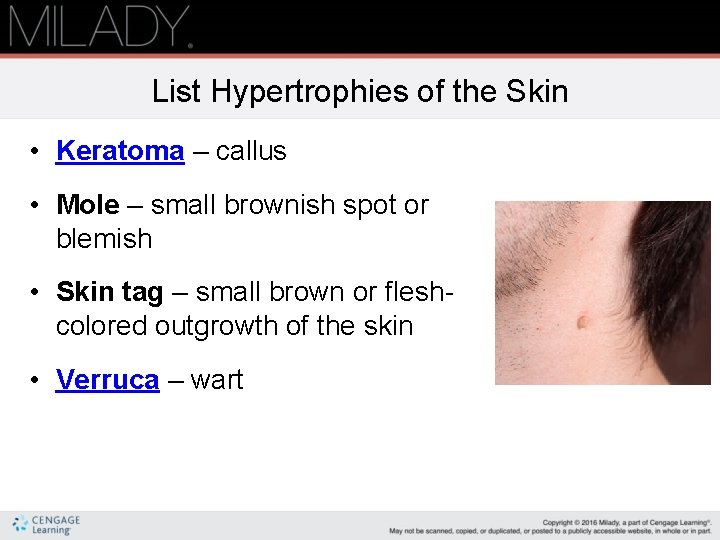 List Hypertrophies of the Skin • Keratoma – callus • Mole – small brownish