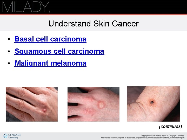 Understand Skin Cancer • Basal cell carcinoma • Squamous cell carcinoma • Malignant melanoma