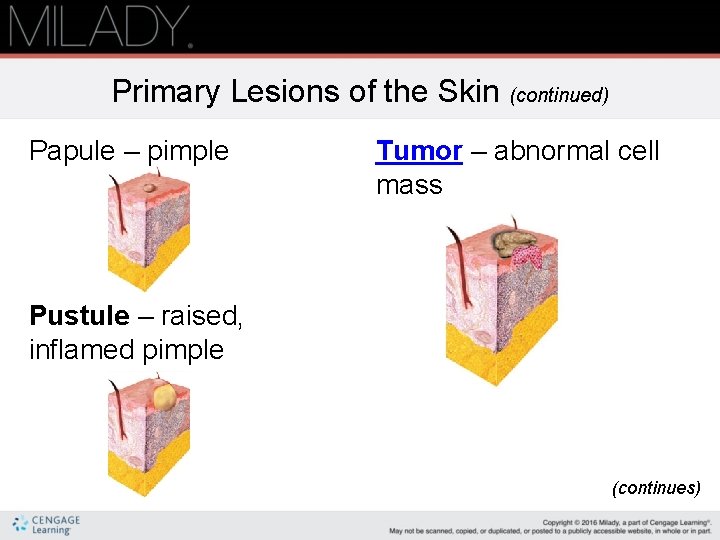 Primary Lesions of the Skin (continued) Papule – pimple Tumor – abnormal cell mass